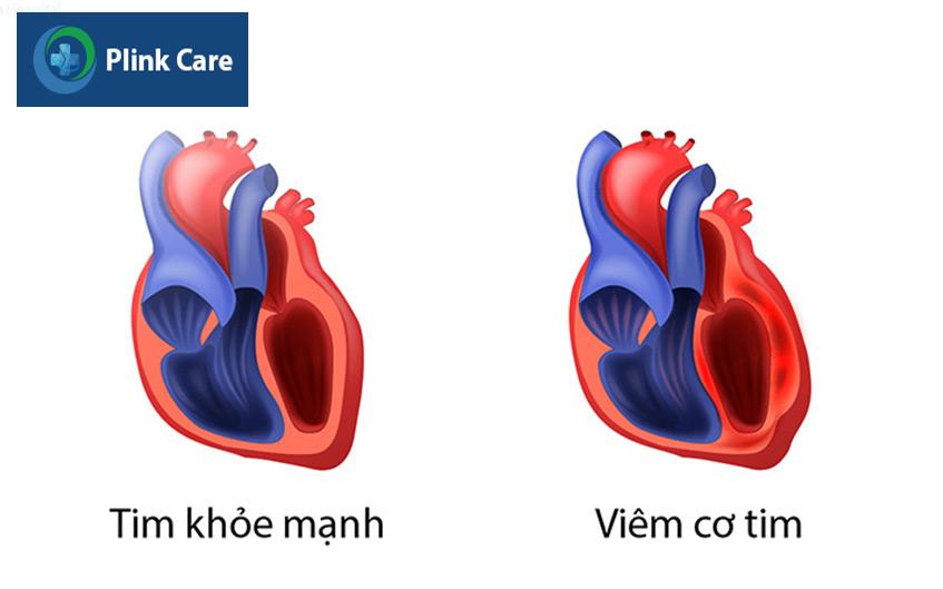 Bệnh viêm cơ tim gây ra triệu chứng đánh trống ngực liên tục