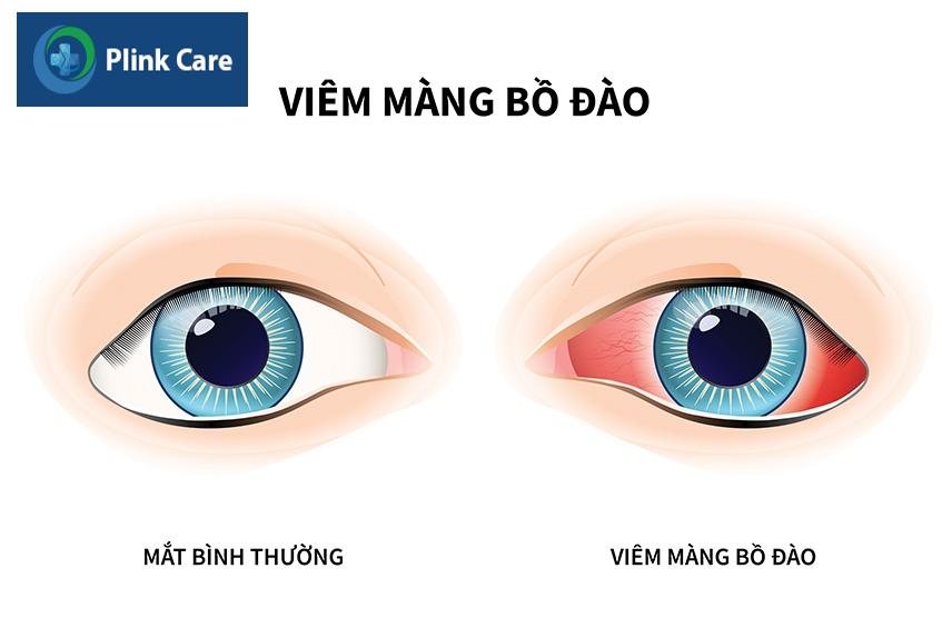 Viêm màng bồ đào