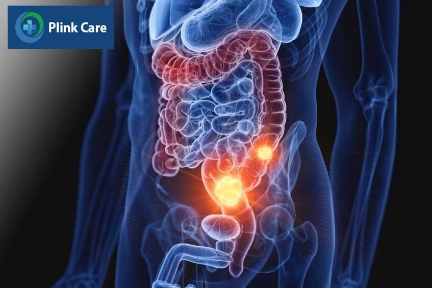 xác định ung thư đại tràng có chữa được không