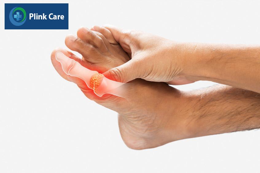 Người bệnh gút cần ăn thực phẩm chứa ít nhân purine