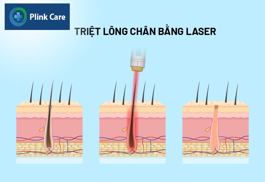 ảnh minh họa triệt lông chân bằng laser