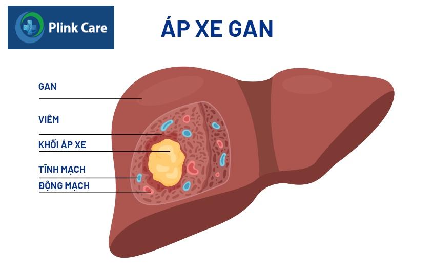 áp xe gan là gì