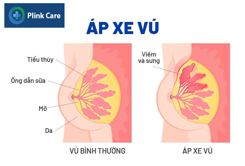 áp xe vú là gì