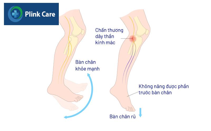 bàn chân rũ gây khó khăn trong việc di chuyển