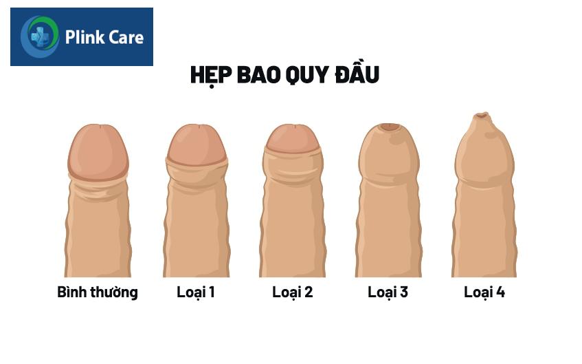 Bao quy đầu bình thường và 4 mức độ hẹp bao quy đầu