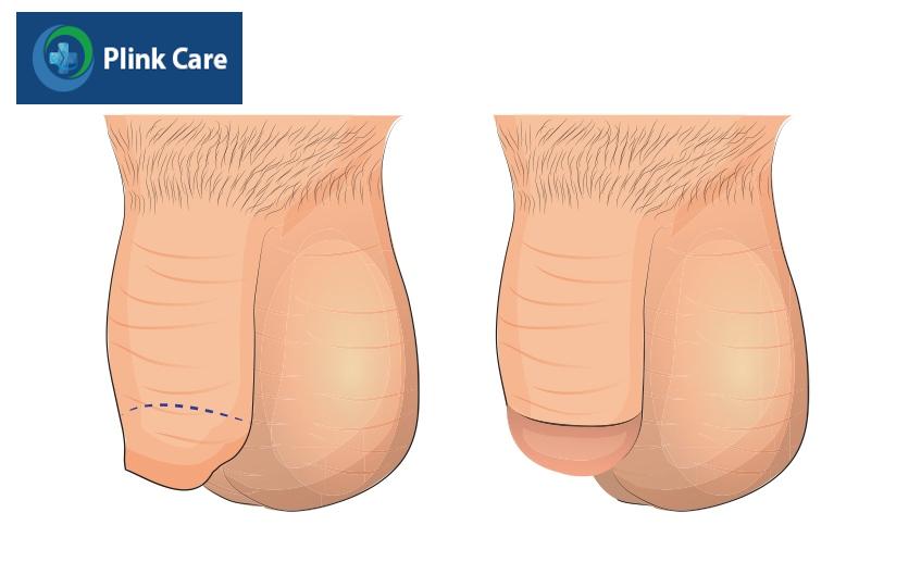 Bao quy đầu dài ở trẻ em là gì