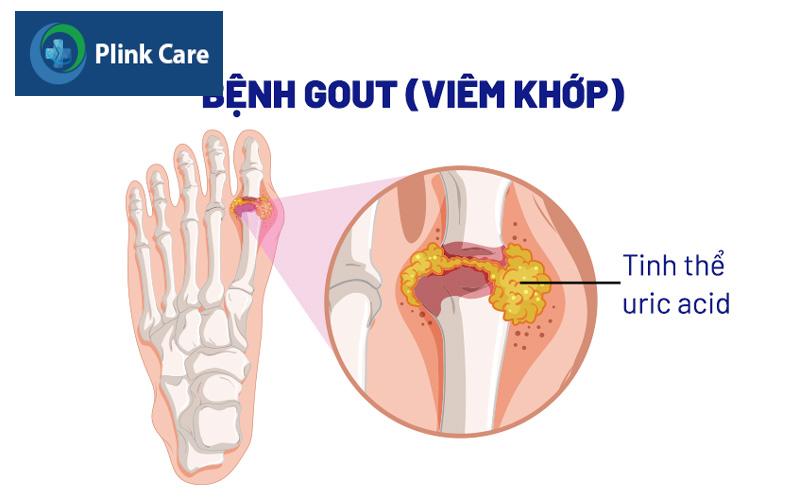 Bệnh gout do acid uric dư thừa