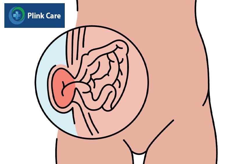bị thoát vị kẹt