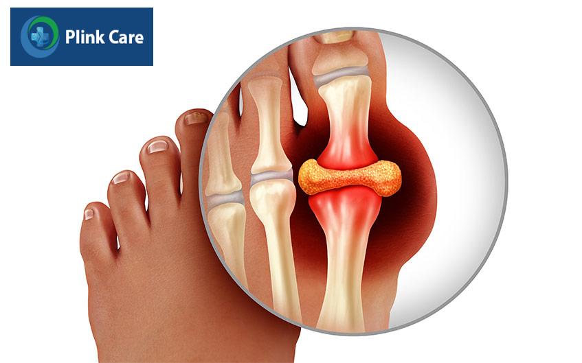bị viêm khớp ở ngón chân cái