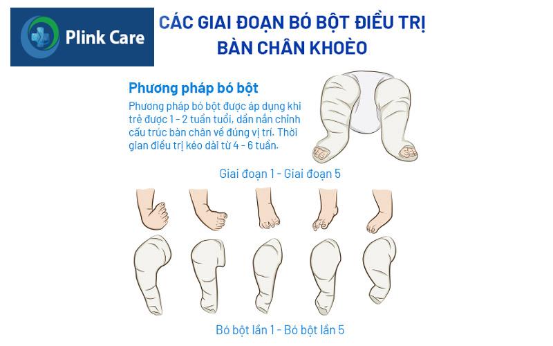 Bó bột chân cho trẻ