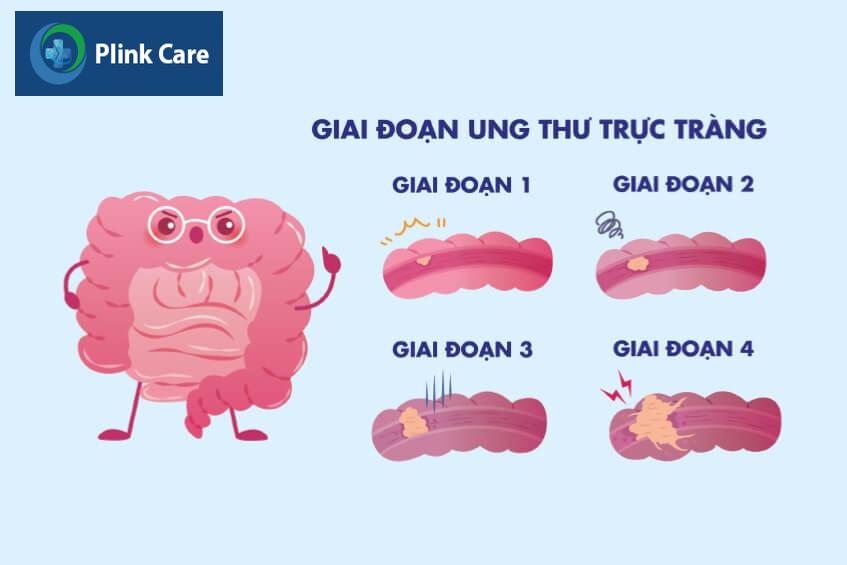 các giai đoạn của bệnh ung thư đại tràng
