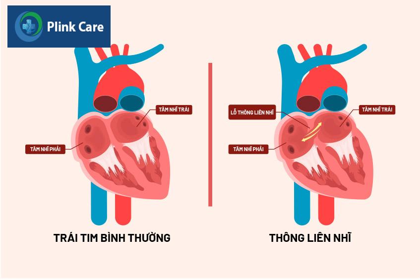 Cấu trúc tim bình thường và cấu trúc tim thông liên nhĩ