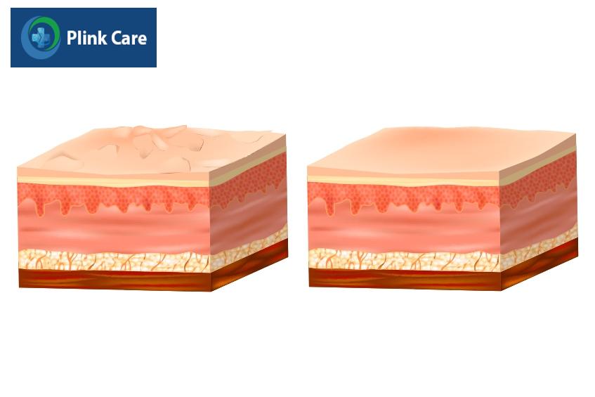 cấu trúc và bề mặt da trước và sau khi peel