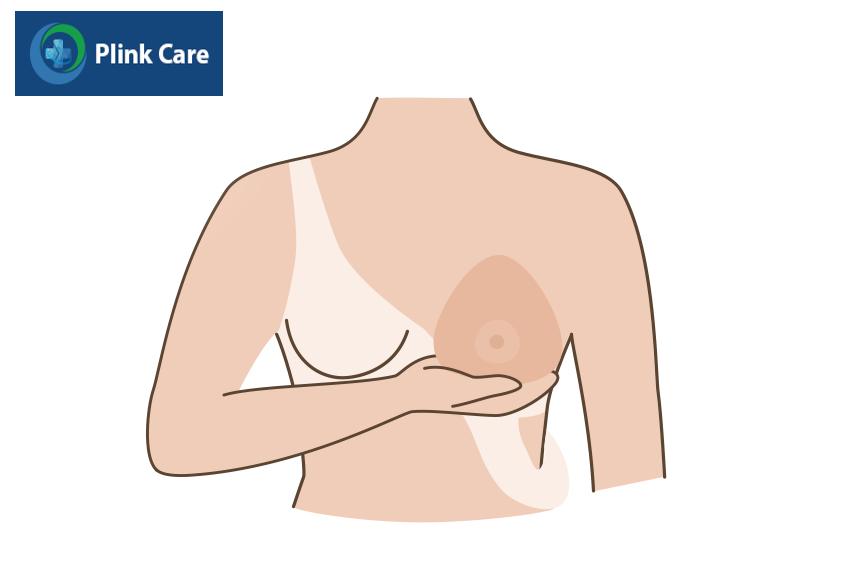Chăm sóc ống dẫn lưu sau mổ tuyến vú