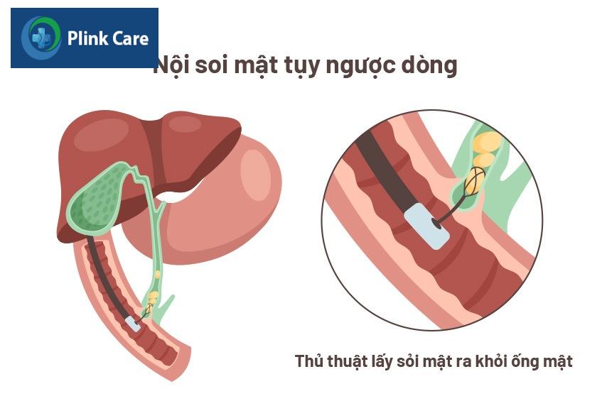 chẩn đoán tắc ống mật