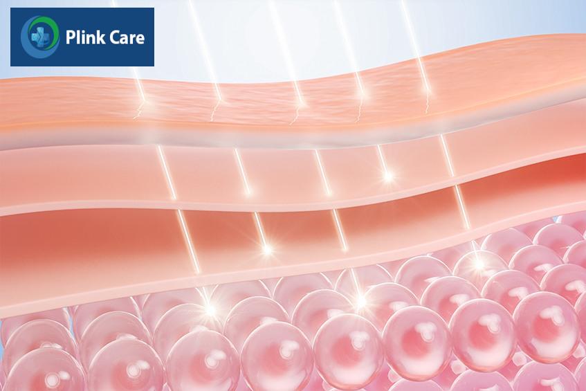 cơ chế hoạt động laser trị nám