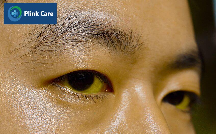 dấu hiệu nhiễm độc gan