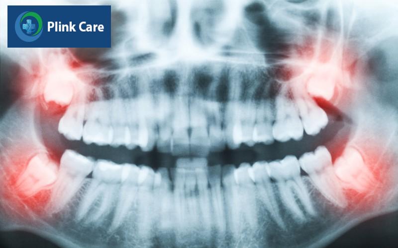 Vì sao răng khôn mọc lệch?