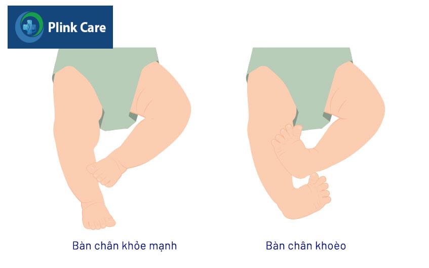 Dị tật bàn chân khoèo gây nhiều khó khăn trong sinh hoạt của trẻ sau này