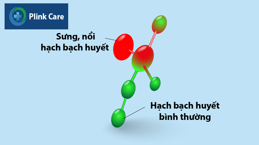 Hạch nổi ở cằm có thể có kích thước nhỏ hoặc lớn