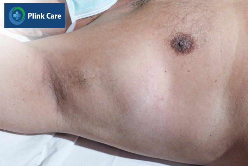 Hạch ở nách có thể nằm ở một số vị trí khác nhau