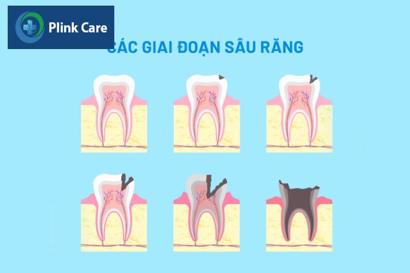 Nguyên nhân gây mất răng, sâu răng
