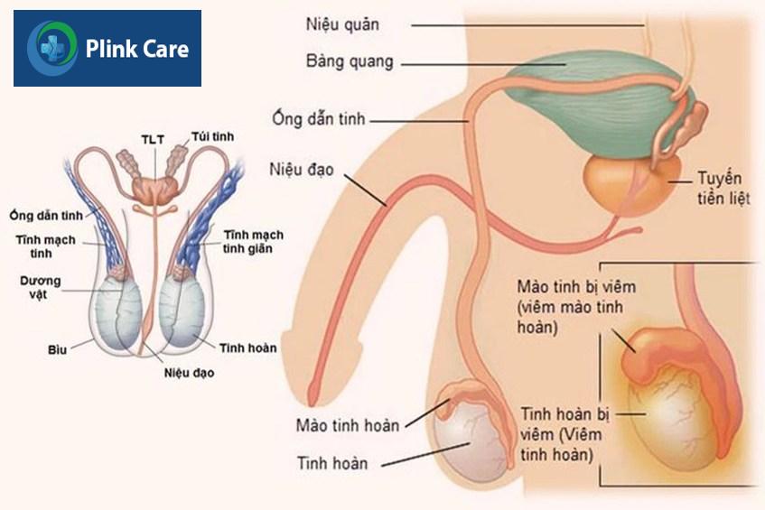 hình ảnh giãn tĩnh mạch thừng tinh