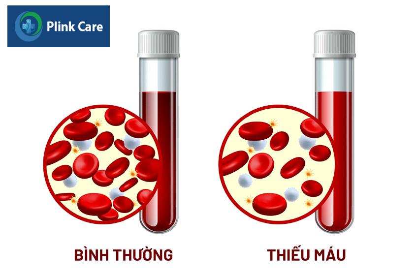 không đủ nguyên liệu sản xuất hồng cầu