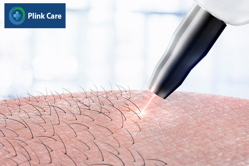 lợi ích khi lựa chọn triệt lông