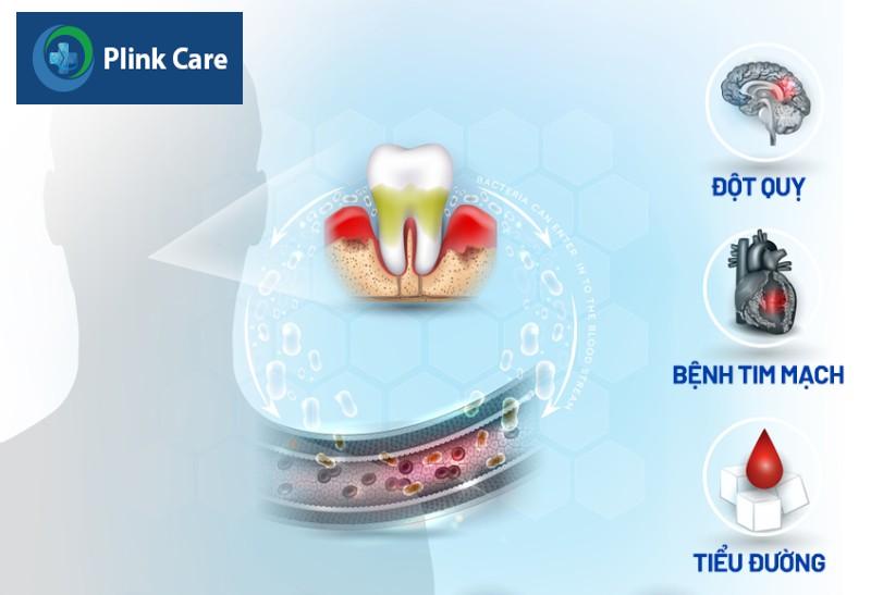 Biến chứng nguy hiểm khi viêm lợi trùm