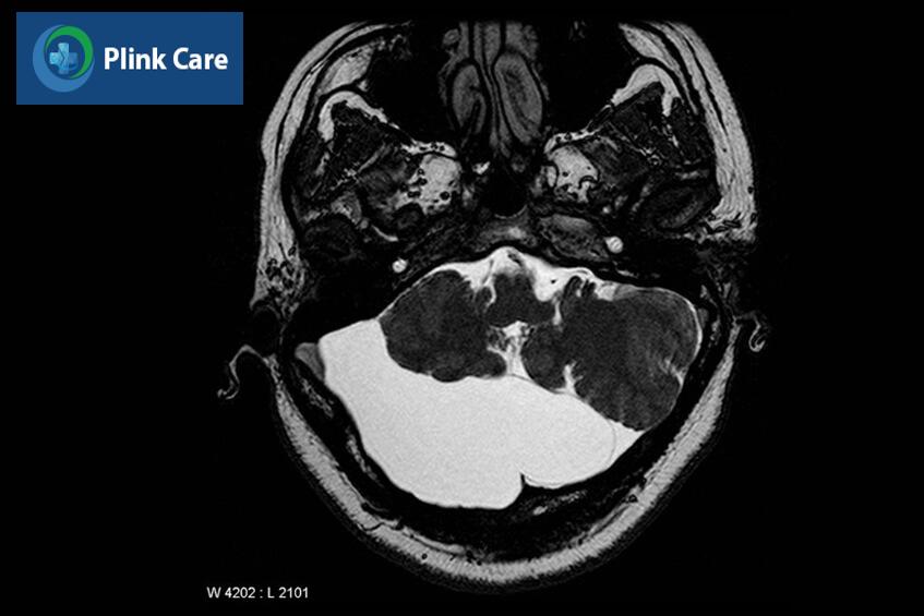 mri u nang màng nhện hố sau