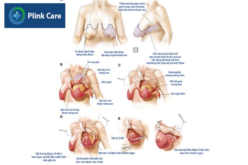 nâng ngực bằng vạt mô