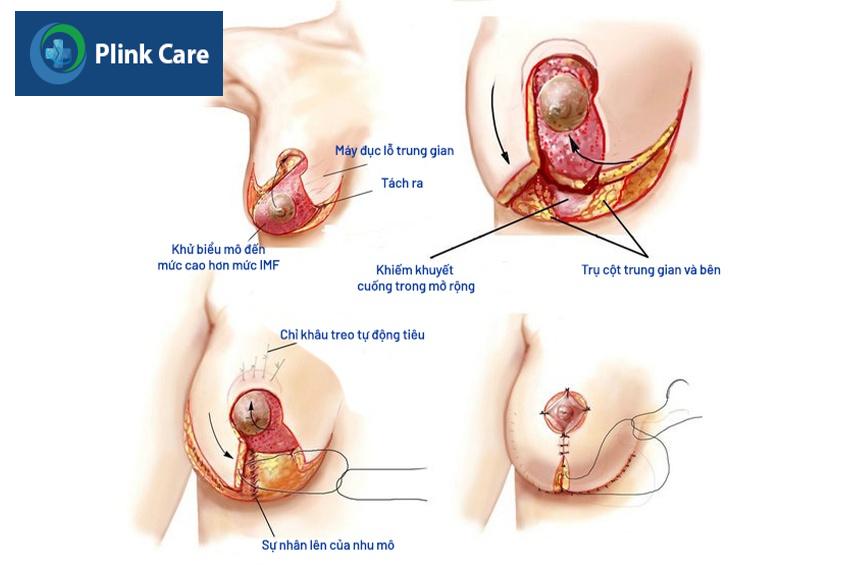 nâng ngực ngực bằng vạt tự thân