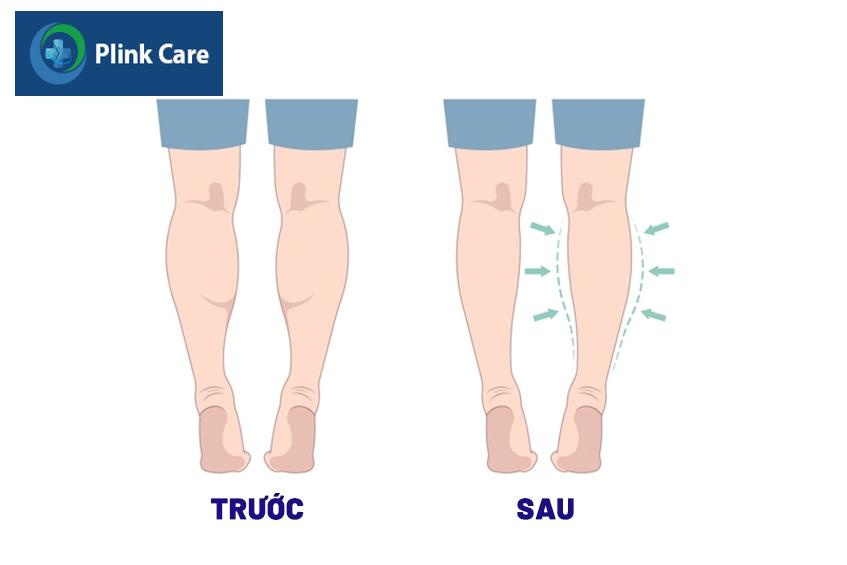 nên tiêm botox bắp chân không