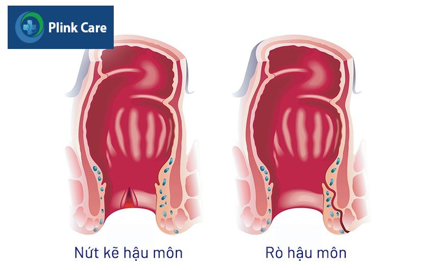 nứt kẽ hậu môn có tự khỏi