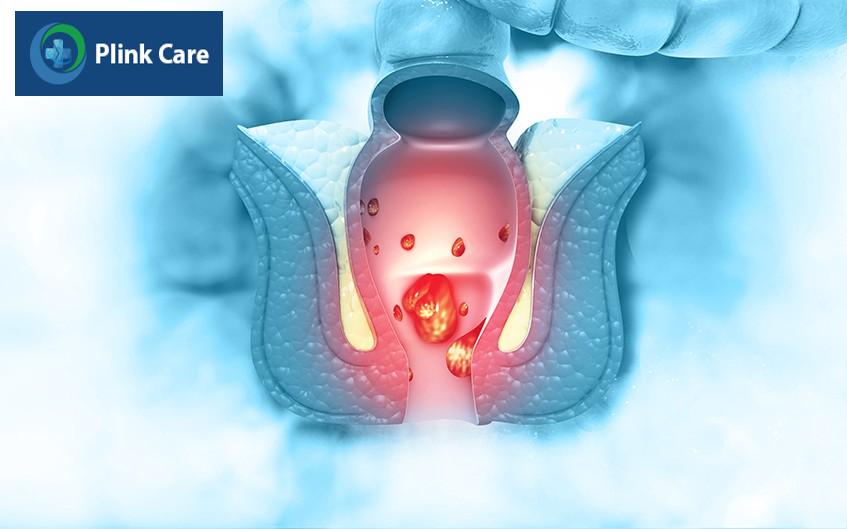 phân biệt giữa trĩ và nứt hậu môn