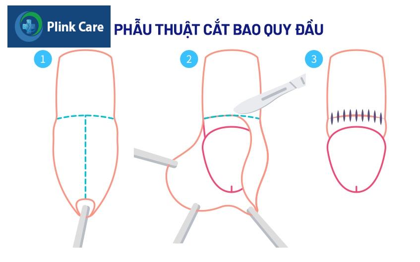 Phẫu thuật cắt bao quy đầu ở trẻ