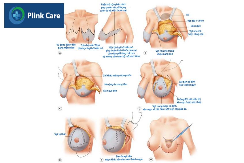 phẫu thuật nâng ngực bằng mô vú tự thân