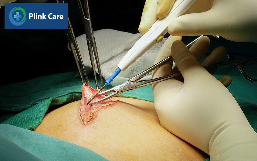phẫu thuật thoát vị thành bụng