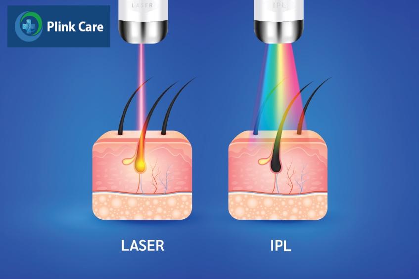 phương pháp triệt lông nách vĩnh viễn hiệu quả