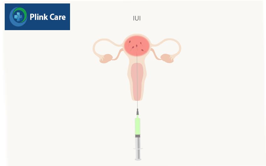 Quá trình tinh trùng gặp trứng sau khi bơm IUI có thể kéo dài từ vài giờ cho đến 2-3 ngày