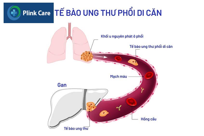 quá trình ung thư di căn
