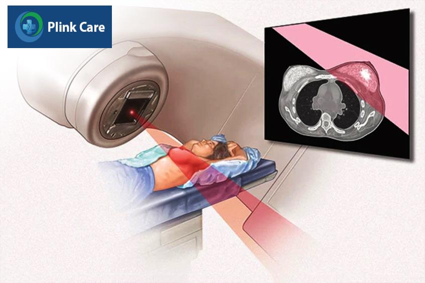 quy trình chụp xạ trị ung thư vú