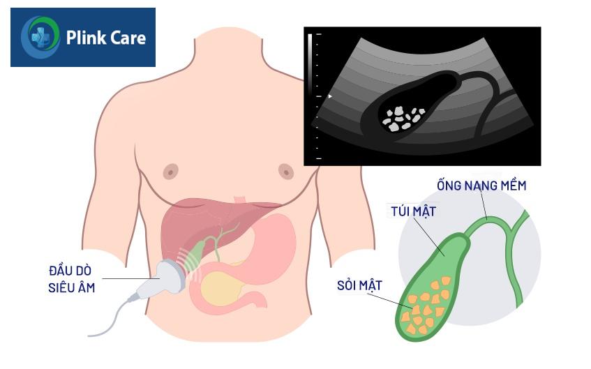 quy trình nội soi lấy sỏi ống mật chủ
