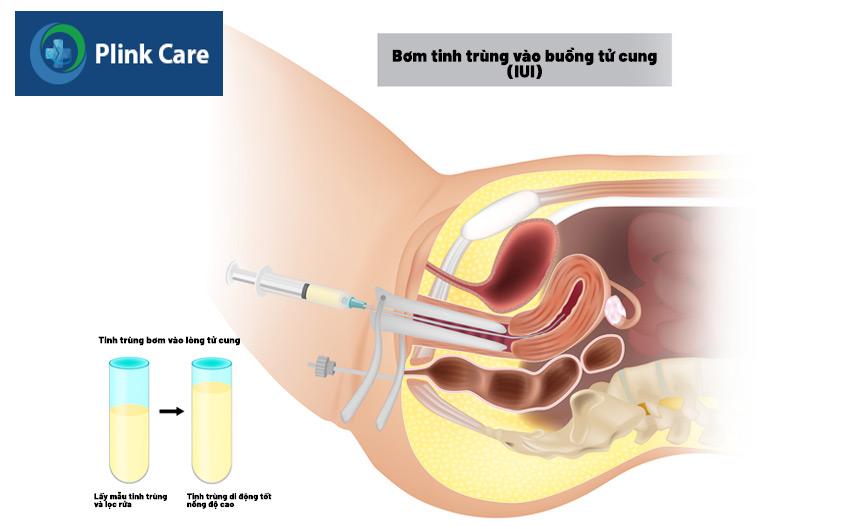 Sau khi bơm bao lâu thì tinh trùng gặp trứng, liệu thời gian có ngắn hơn so với quá trình thụ thai tự nhiên?