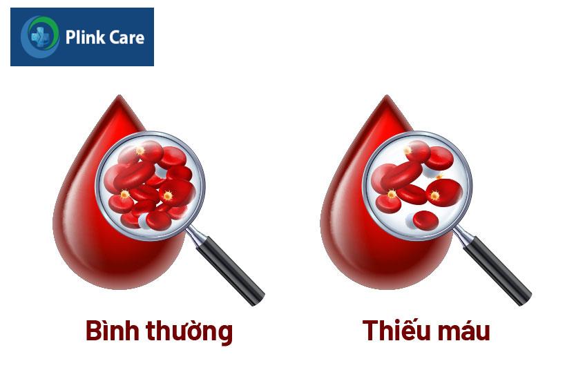 Thiếu máu khiến số lượng hồng cầu hoặc nồng độ huyết sắc tố trong trong hồng cầu thấp