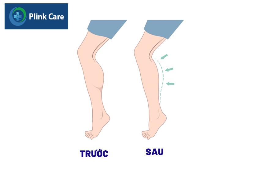 tiêm botox thon gọn bắp chân trước và sau
