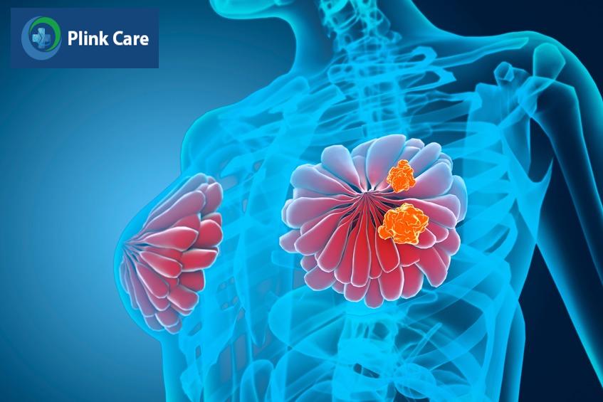 tốc độ phát triển của ung thư vú