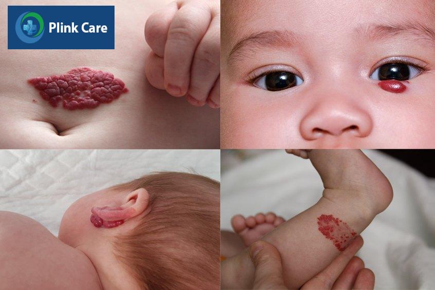 Trẻ có thể có nhiều bướu máu ở nhiều vị trí