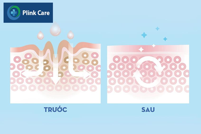 trị nám bằng laser